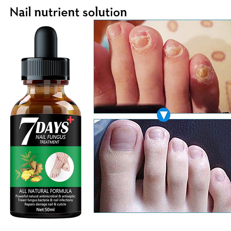 Essence de traitement des mycoses des ongles 7DAYS