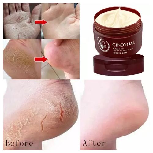 Crème anti-déchirure pour les pieds