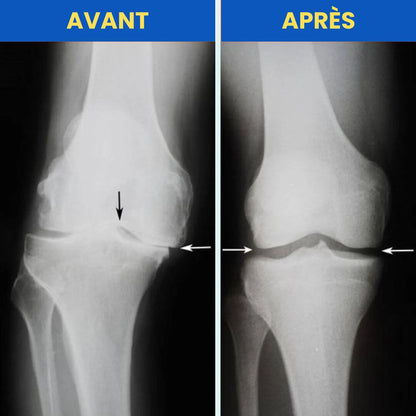 Genouillère Rotulienne NeuroGenoux — Réalignez l'Articulation du Genou Pendant vos Mouvements