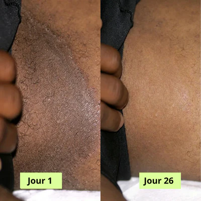 Savon Purifiant Antifongique (Homme & Femme ) : 1 achetés = 1 offert