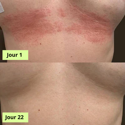 Savon Purifiant Antifongique (Homme & Femme ) : 1 achetés = 1 offert